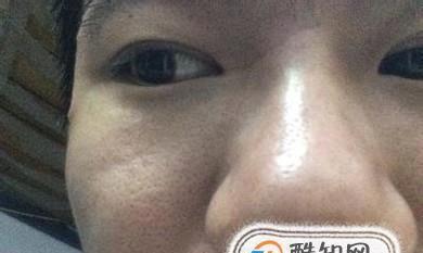 摆脱毛孔粗大的烦恼（独家方法助您拥有细致无瑕的肌肤）