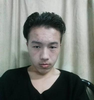 消除额头痘痘的小妙招（15个简单方法告别额头痘痘）
