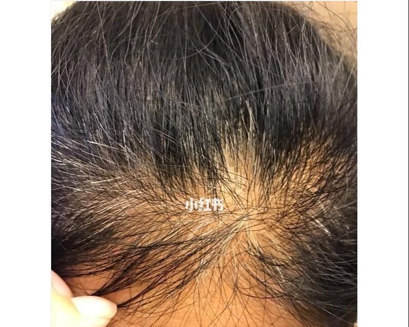 少年白怎么办能恢复（探索少年白恢复的有效方法）