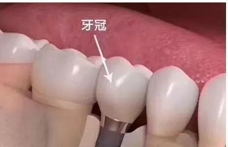 数据线压痕如何修复？修复后是否会影响使用？