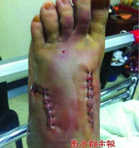 电瓶车水泥钉怎么拆？拆卸方法有哪些？
